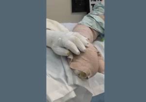 Jamie and Jacob Hyland touching hands while recovering from serious burns from fleeing a wildfire earlier this month. Courtesy photo/Harborview Medical Center.