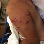 On July 4, 2017, Auburn Police Officer Timothy Nunn initiated a K9 track on Elmer Gomez-Evaristo after he fled from a hit-and-run that resulted in injuries to a woman. The K9 attacked Gomez-Evaristo after discovering him lying on his back, resulting in his hospitalization. (Photo from the Auburn Police Department)