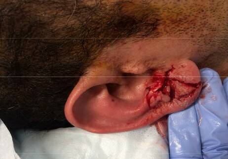 Photos courtesy of Auburn Police Department
On March 28, 2017, Auburn Police Officer Timothy Nunn initiated a K9 track after Leslie Hunkin using K9 Jax. Hunkin previously fled from a moving vehicle after eluding police. K9 Jax discovered Hunkin behind trash bins on a back porch and attacked Hunkins head, resulting in punctures on his right ear and left cheek, according to public records. (Photo from the Auburn Police Department)