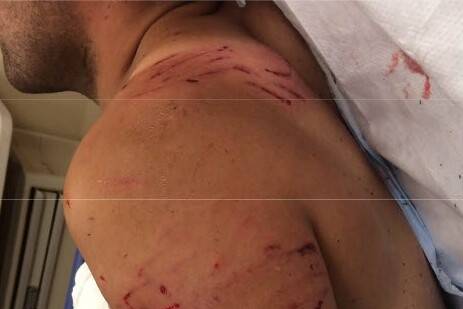 On July 4, 2017, Auburn Police Officer Timothy Nunn initiated a K9 track on Elmer Gomez-Evaristo after he fled from a hit-and-run that resulted in injuries to a woman. The K9 attacked Gomez-Evaristo after discovering him lying on his back, resulting in his hospitalization. (Photos courtesy of Auburn Police Department)