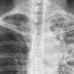 COURTESY IMAGE, Public Health - Seattle & King County